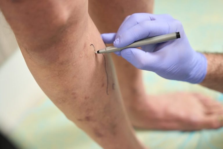 reabilitação vascular