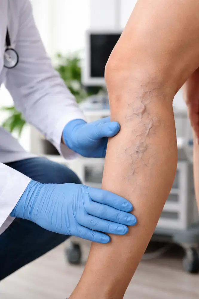 Doença Venosa Crônica Sintomas Causas e Tratamento